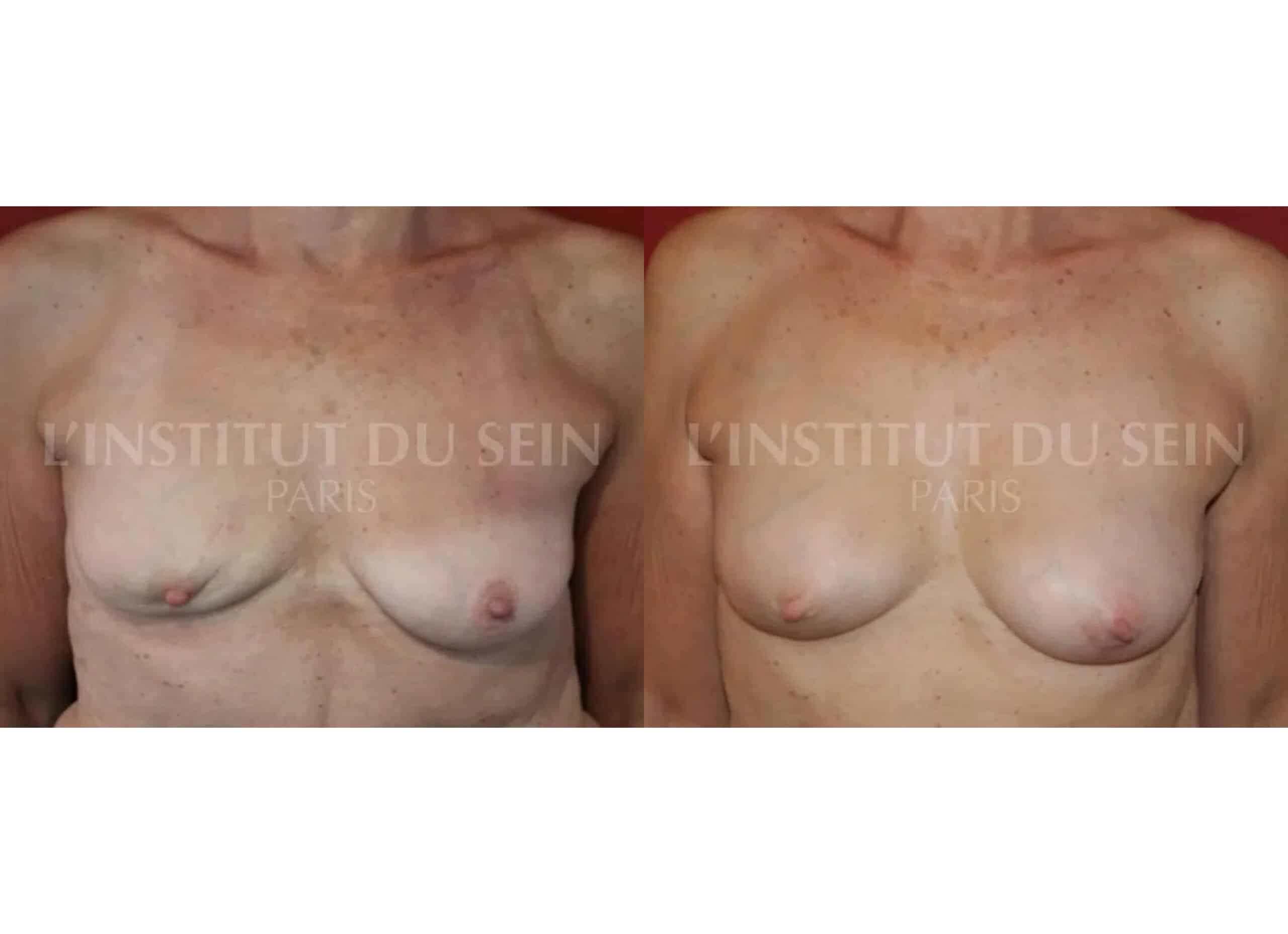 Poitrine avant/apres tumorectomie sein droit et radiotherapie filling sein droit et redrapage sein gauch institut du sein paris