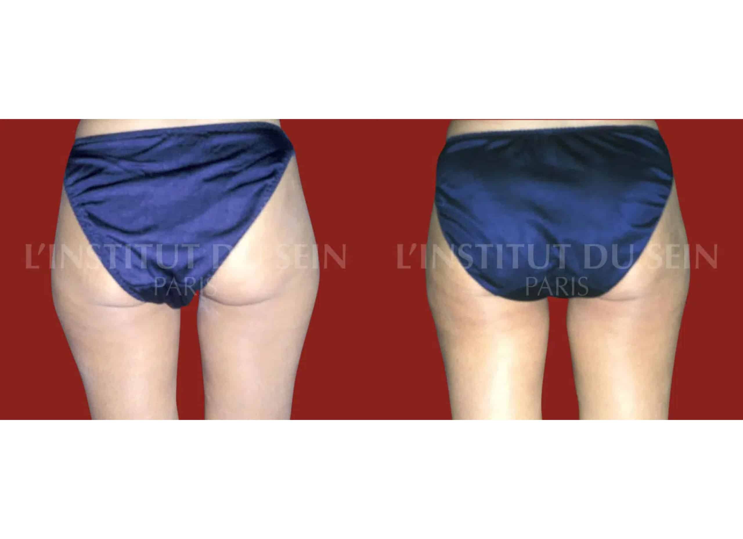 Fesses de femme avant /apres operation de liposuccion chirurgie esthetique insitut du sein paris
