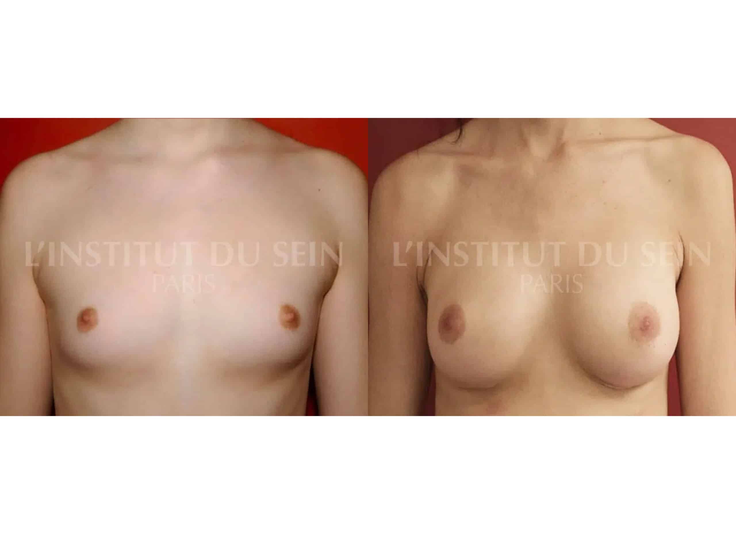 Poitrine avant/apres pose de deux protheses par dual plane institut du sein paris