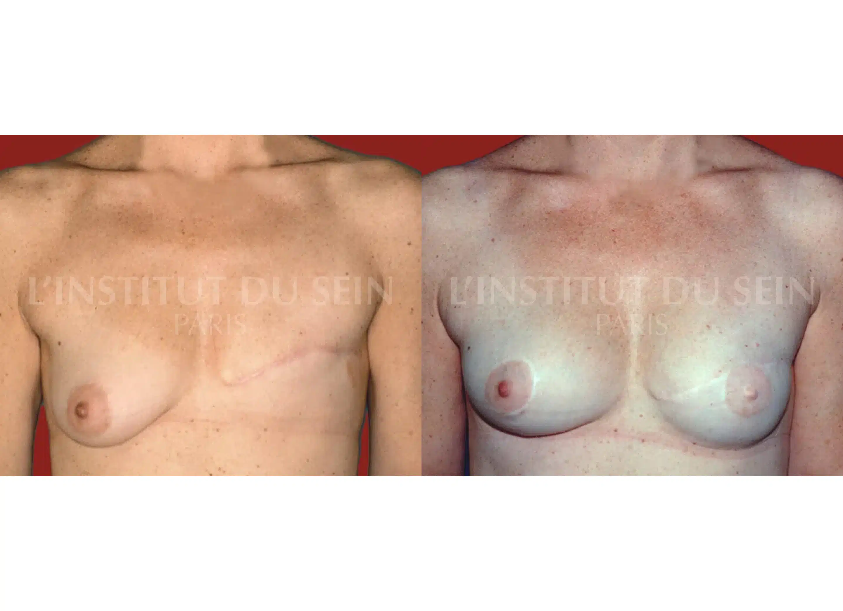 Poitrine avant/apres Reconstruction par lambeau local pour le mamelon et greffe de peau pour lareole institut du sein paris