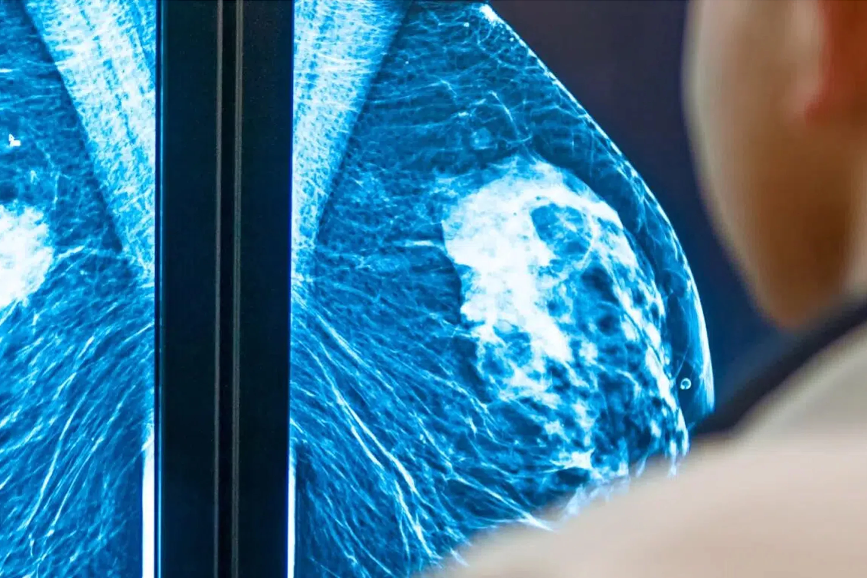 Mastectomie prophylactique