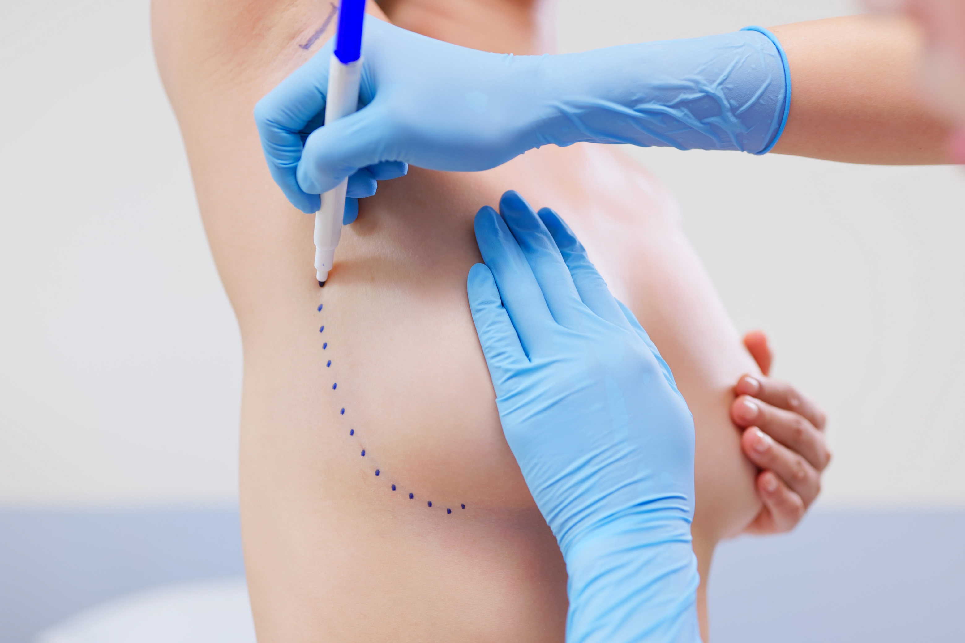 Augmentation mammaire transgenre | Institut du Sein | Paris