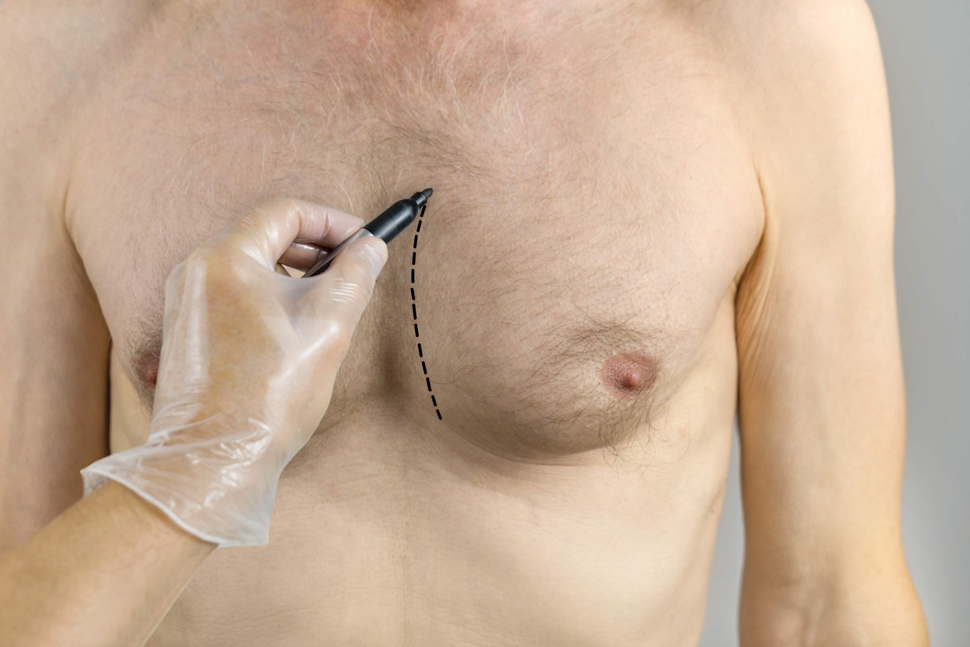 Chirurgie de la gynécomastie | Institut du Sein | Paris